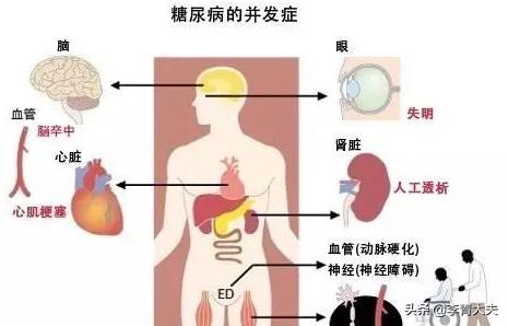 恶型糖尿病(恶性糖尿病)