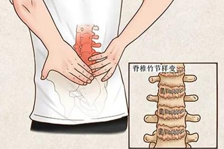 肥胖脊柱疼(肥胖会导致脊柱疼吗)