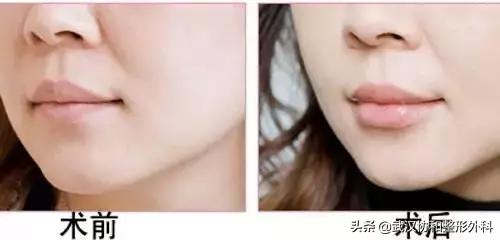 常见的唇部整形都有哪些，唇部整形有什么方法