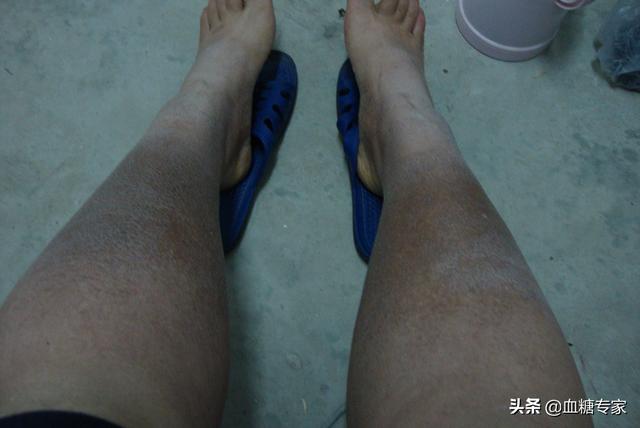 小腿皮肤发黑图片，脚小腿皮肤变黑是什么原因