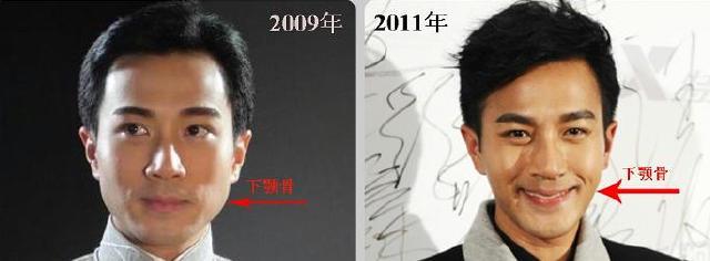 男星也微整？打玻尿酸、填充脂肪，有多少人假面且同化 娛樂八卦吃瓜 第11张