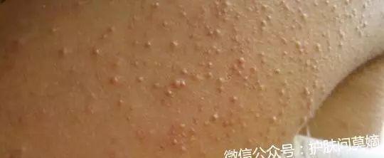 逆光疹会自愈吗，逆光疹开始变好的征兆（易混淆闭合性粉刺、皮脂腺增生）