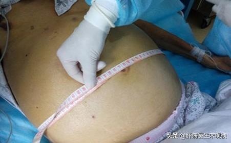 肥胖与腹水(肥胖腹水怎么分别)