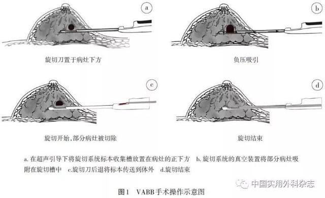 乳腺微创麦默通术是啥，乳房肿块手术是选择微创好