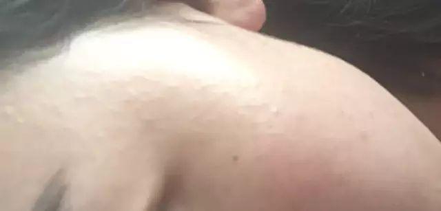 逆光疹会自愈吗，逆光疹开始变好的征兆（易混淆闭合性粉刺、皮脂腺增生）