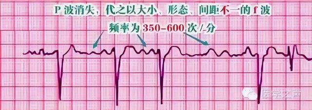 一分钟快速看懂心电图，1分钟教你看懂心电图