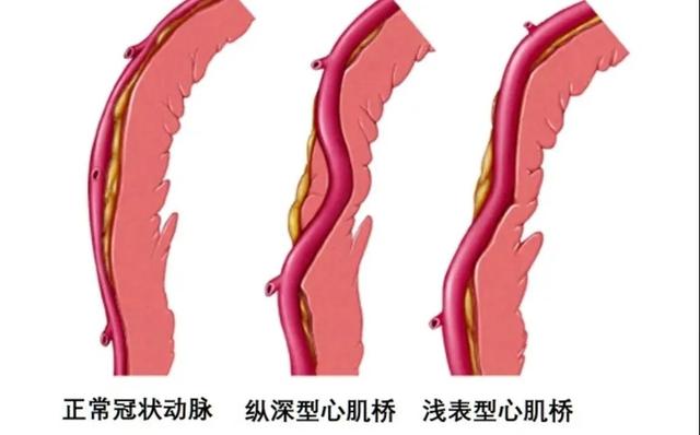 冠状动脉肌桥属于先天性疾病吗，冠状动脉肌桥属于什么病