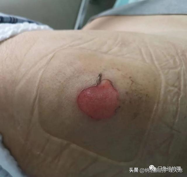 肥胖腿根破皮(肥胖腿根破皮怎么办)