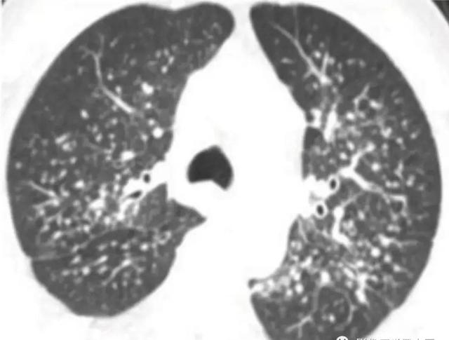 肺结核的分型诊断标准，肺结核的分型及影像学表现