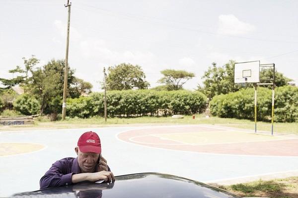 人类白化病的直接原因，非洲的白化病人