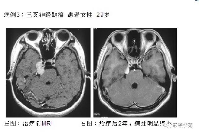 面部血管分布图，三叉神经分支及面部分布规律（玻尿酸怎么打，才会避免栓塞呢）