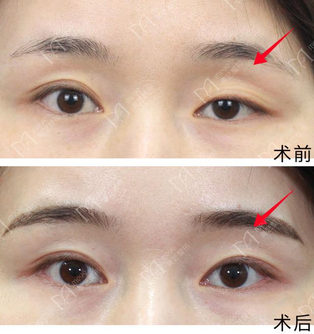 大小眼自我矫正方法，大小眼矫正方法（如何矫正大小眼）