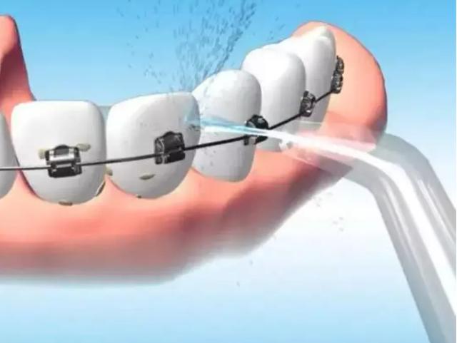 戴牙套后必须要注意的，戴上牙套后如何做好日常护理