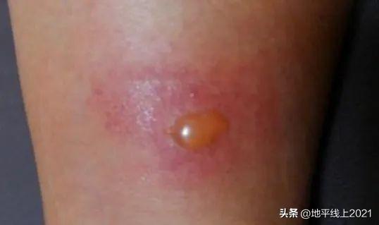 被蚊子咬了红肿特别大怎么办，蚊虫叮咬起大包（蚊虫叮咬起了大包怎么办不过血了）