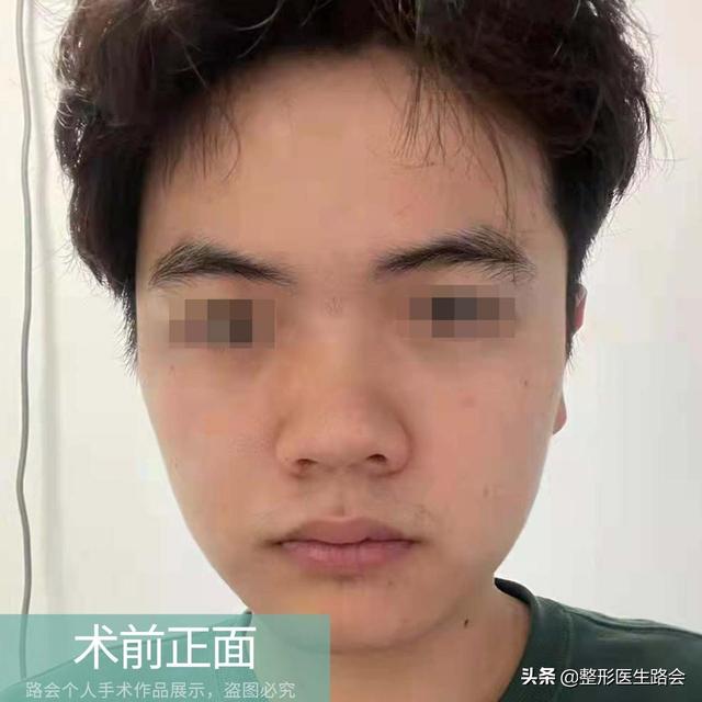 男子隆鼻一年后的真实感受，男子花1.2万隆鼻后竟能晃动