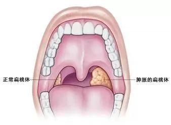 咽立爽口含滴丸糖尿病(咽立爽口含滴丸的副作用)