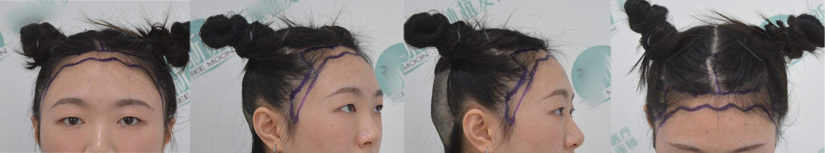 一图解析植发手术全流程，揭秘植发手术的全过程