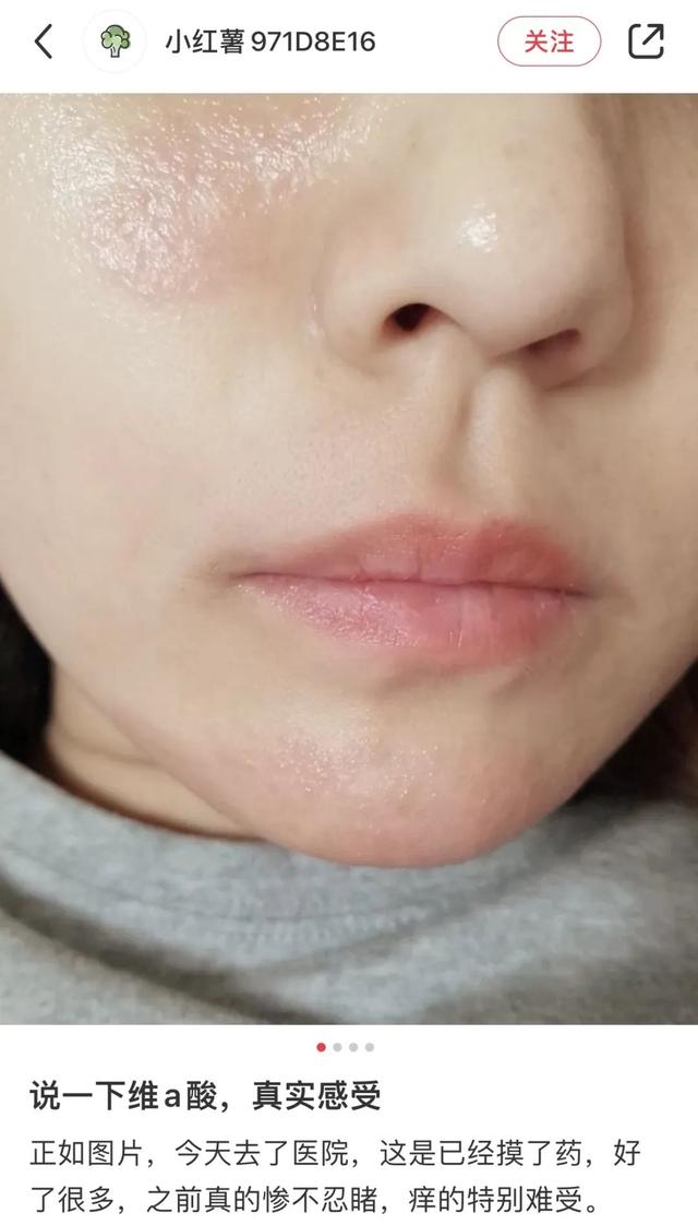 缩毛孔最有效方法，收缩毛孔最好的方法