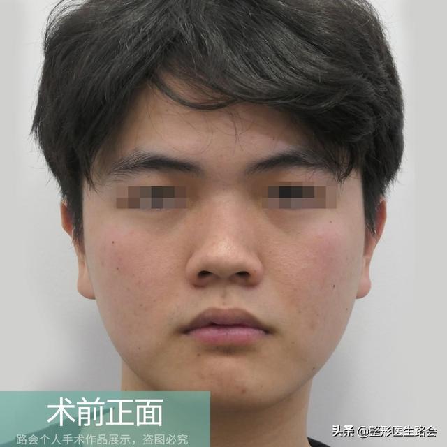 男子隆鼻一年后的真实感受，男子花1.2万隆鼻后竟能晃动