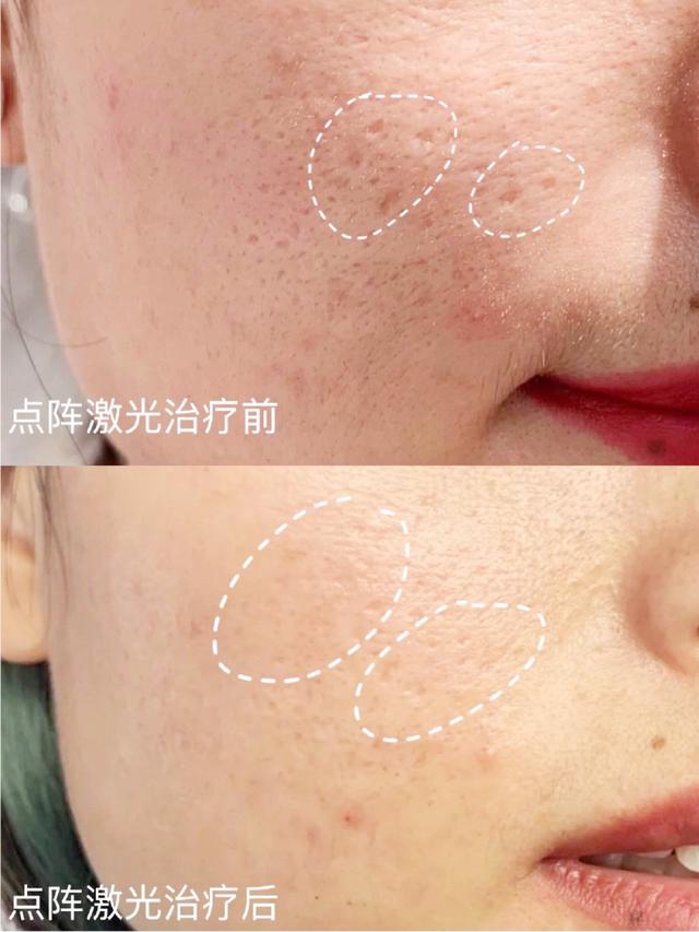 缩毛孔最有效方法，收缩毛孔最好的方法