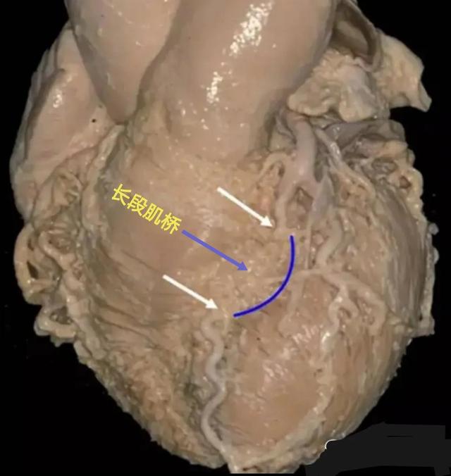 冠状动脉肌桥属于先天性疾病吗，冠状动脉肌桥属于什么病