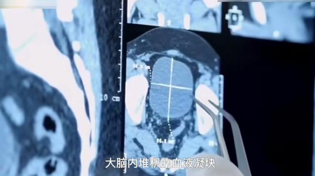 纽约现埃博拉感染者，埃博拉病毒还有救吗（一名埃博拉感染者从刚果）