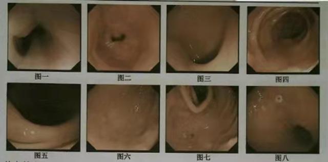 超重和轻度肥胖(超重和轻度肥胖的标准是多少)