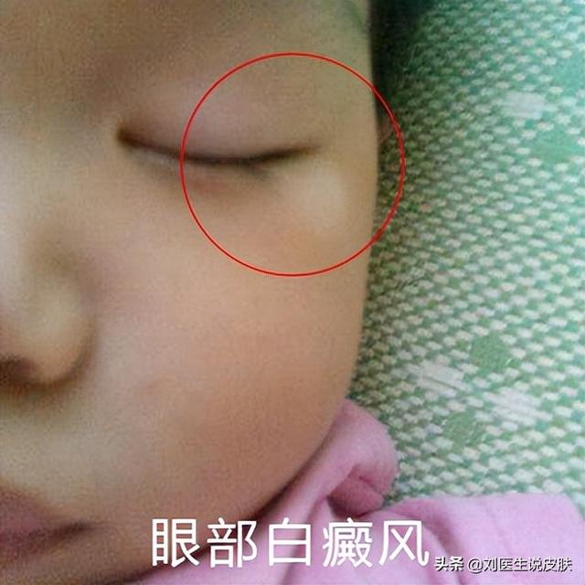 糖尿病白斑(糖尿病 白斑)