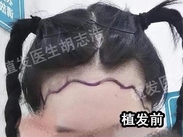 一图解析植发手术全流程，揭秘植发手术的全过程