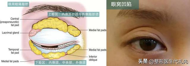 眼窝凹陷怎么填充，眼窝凹陷怎么填充的过程