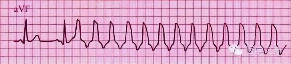一分钟快速看懂心电图，1分钟教你看懂心电图