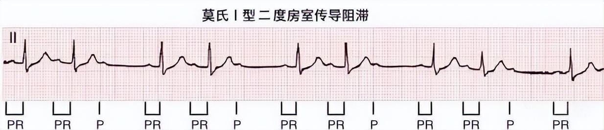 一分钟快速看懂心电图，1分钟教你看懂心电图