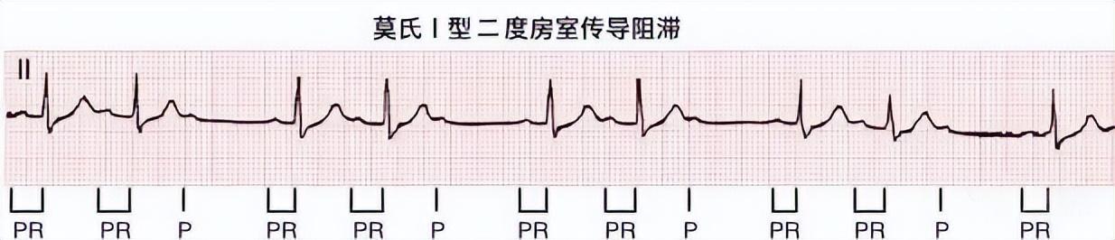 一分钟快速看懂心电图，1分钟教你看懂心电图