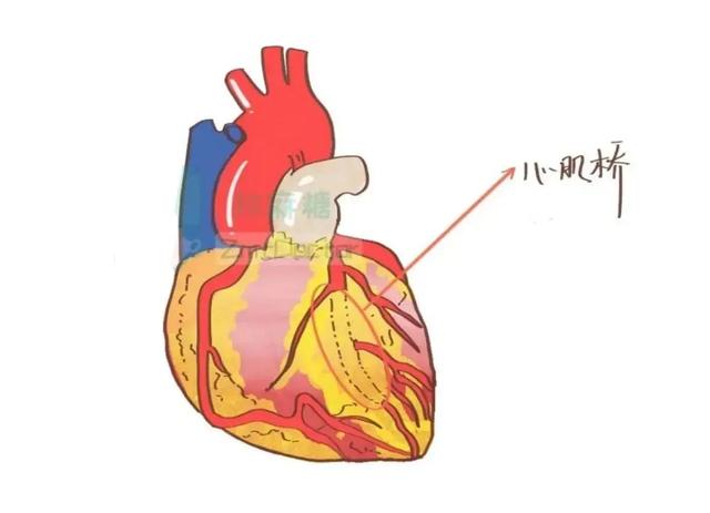 冠状动脉肌桥属于先天性疾病吗，冠状动脉肌桥属于什么病