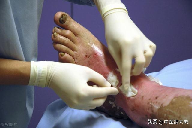 糖尿病脚有什么症状(糖尿病综合症脚烂了能治好吗)