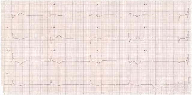 一分钟快速看懂心电图，1分钟教你看懂心电图