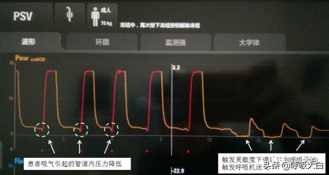 5个呼吸机常见参数设置，呼吸机各种模式需要调的参数（送给临床小白——呼吸机模式及参数设置图文详解）