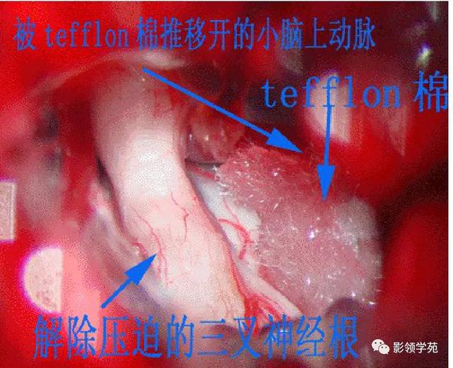 面部血管分布图，三叉神经分支及面部分布规律（玻尿酸怎么打，才会避免栓塞呢）