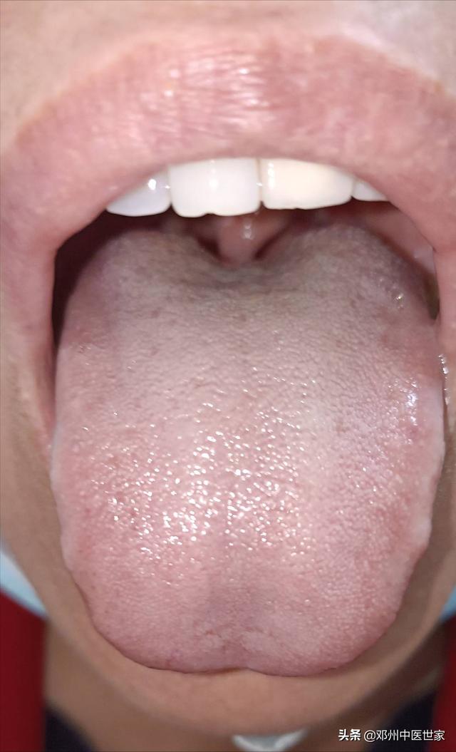 糖尿病皮肤溃烂瘙痒(糖尿病皮肤溃烂特效药)