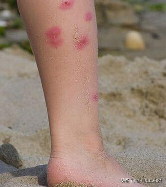 被蚊子咬了红肿特别大怎么办，蚊虫叮咬起大包（蚊虫叮咬起了大包怎么办不过血了）