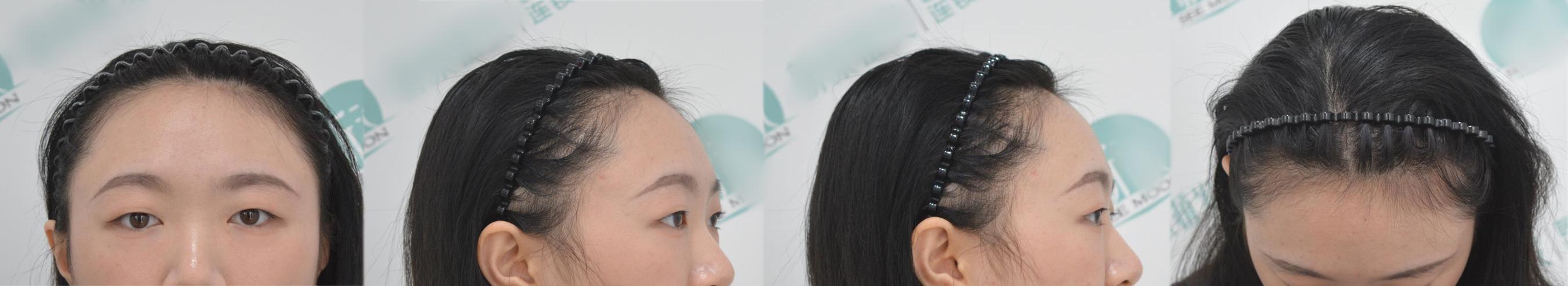 一图解析植发手术全流程，揭秘植发手术的全过程