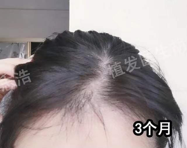 一图解析植发手术全流程，揭秘植发手术的全过程