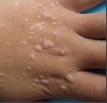 瘊疣平是治疗什么，科普扁平疣（瘊疣平治疗扁平疣效果好吗）