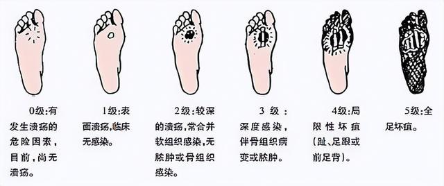 糖尿病脚烂早期信号(糖尿病脚烂早期信号图片)