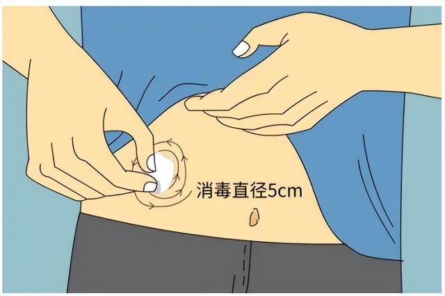 胰岛素怎么打正确方法，胰岛素怎么打最合适（怎样正确注射胰岛素）