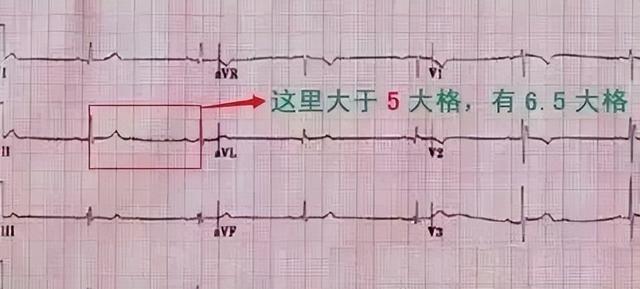 一分钟快速看懂心电图，1分钟教你看懂心电图