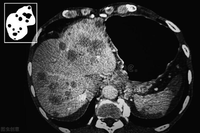 如何看懂增强ct，增强CT你真的了解吗