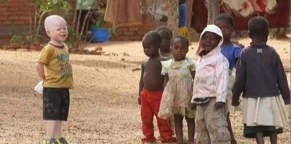 人类白化病的直接原因，非洲的白化病人