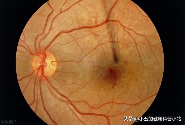 糖尿病黄斑病变眼药水(糖尿病黄斑病变会失明吗)