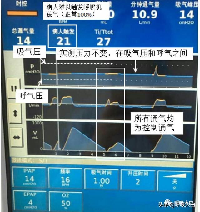 5个呼吸机常见参数设置，呼吸机各种模式需要调的参数（送给临床小白——呼吸机模式及参数设置图文详解）